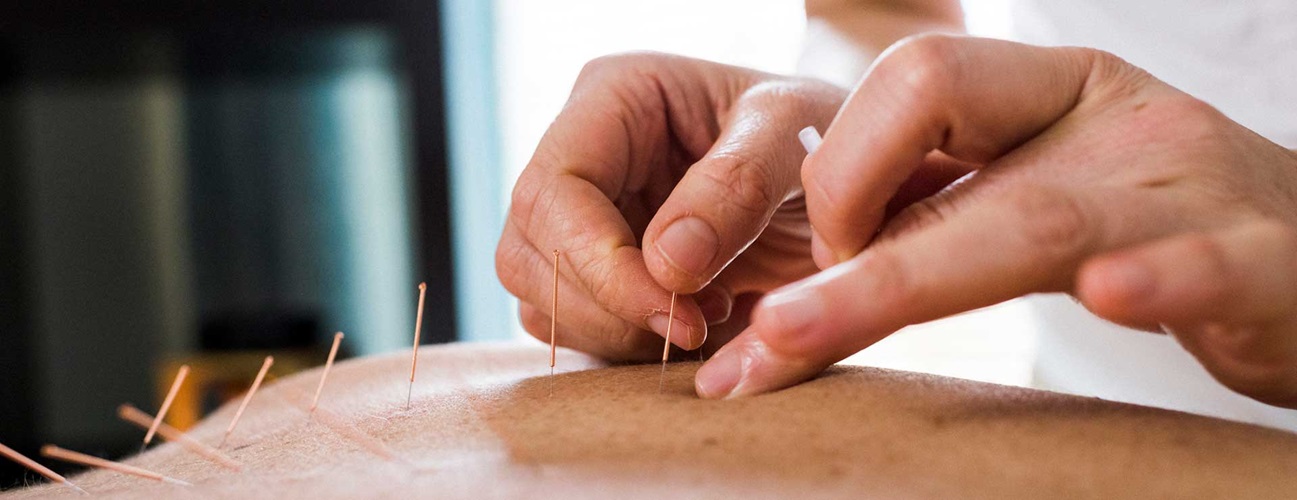 acupuncture needles on patient receiving treatment in clinical setting