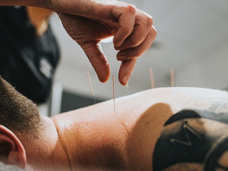 acupuncture needles clinical setup hypertension