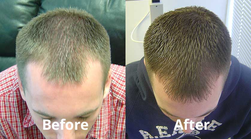 hair restoration clinic treatment