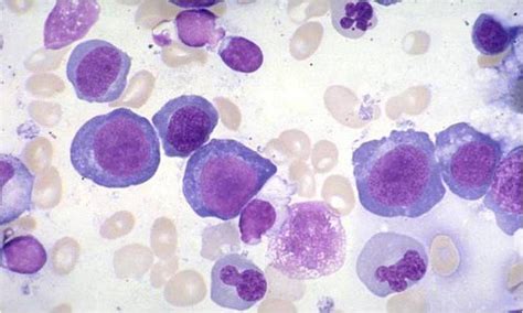 bone marrow exam