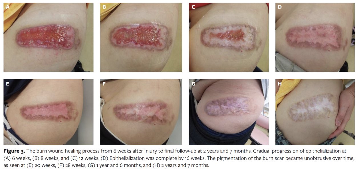 Full-thickness burn wound healing progression