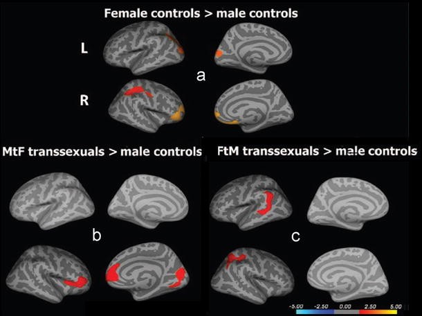 transgender boy girl brain structure