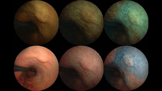 endoscopic view of gastric cancer diagnosis