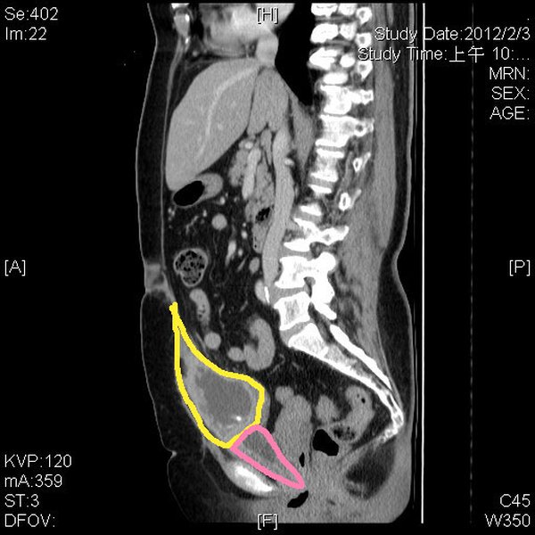 bladder-cancer-low-malignancy-cure-potential-u6qn060q