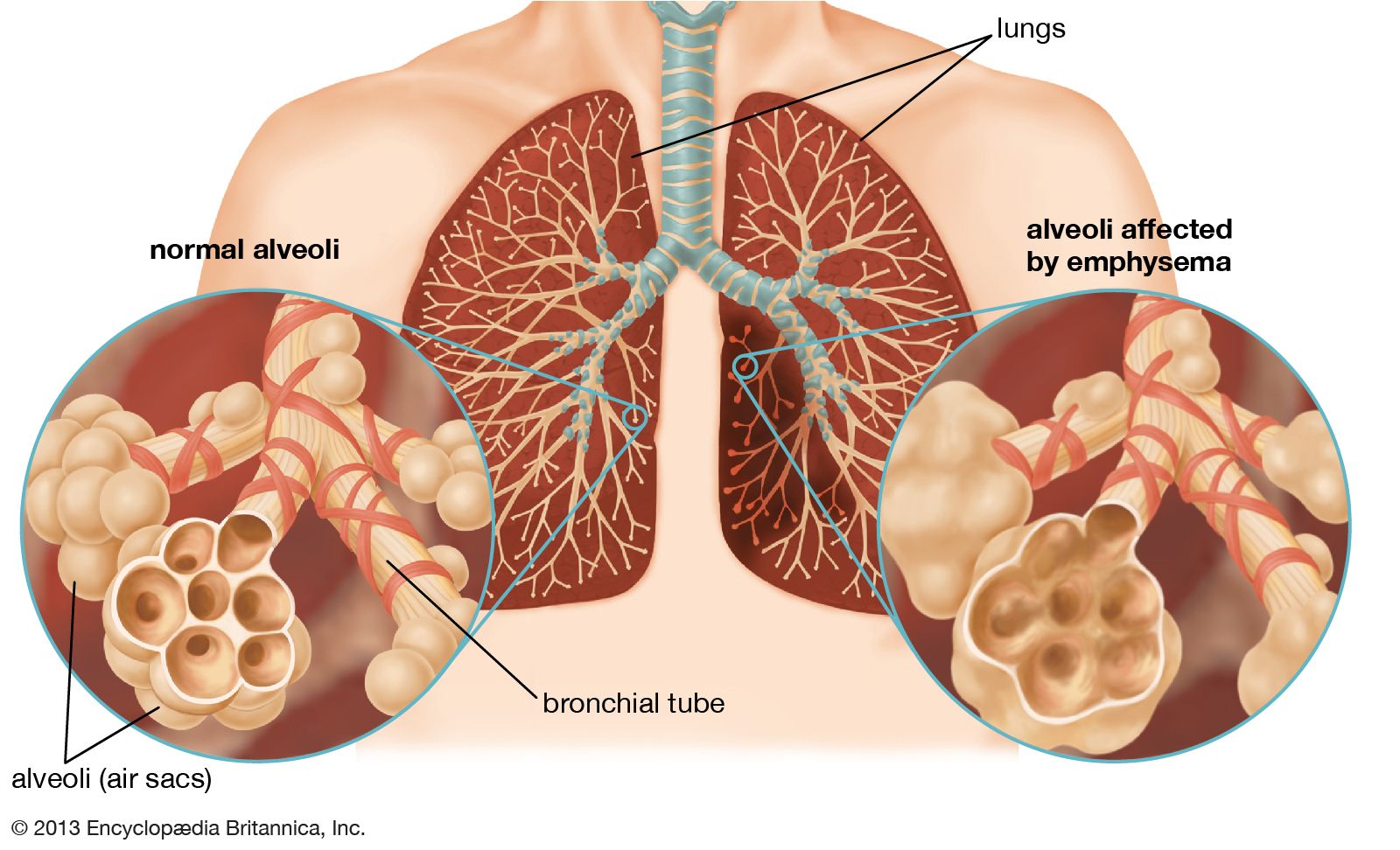 lung tissue damage oxygen therapy