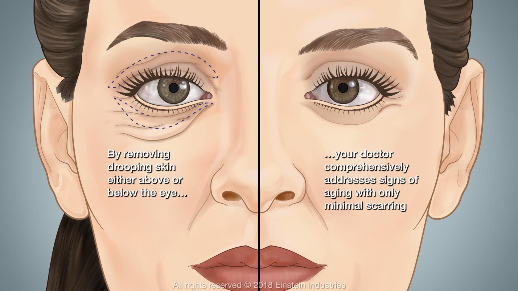 modern chirurgie plastique eyelid surgery