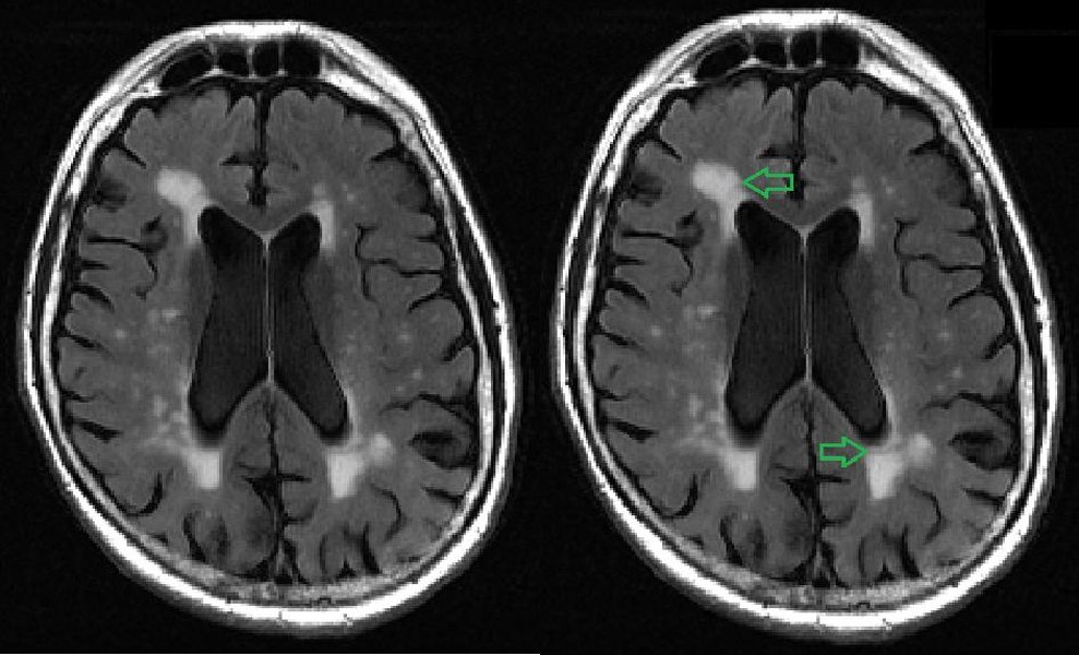 MRI scan showing white matter in the brain