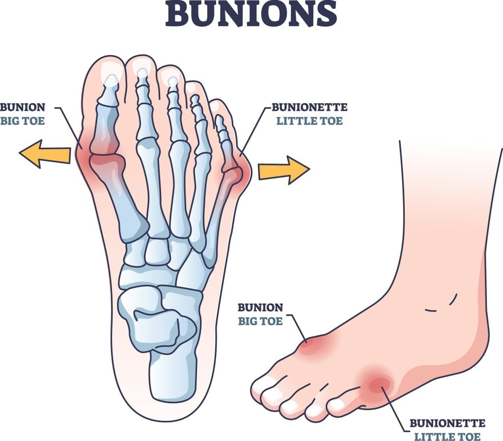 foot structure, bunion deformity, foot care