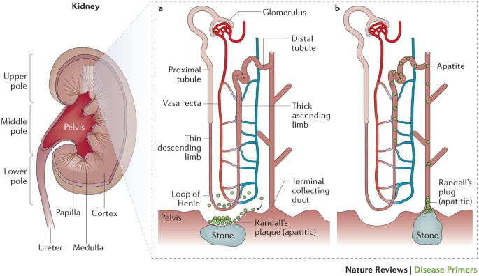 kidney stones urinary calcium dialysis