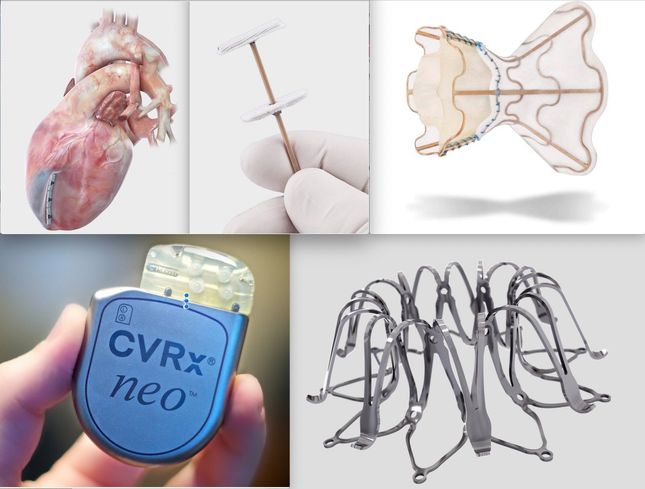cardiomyopathy heart treatment technology