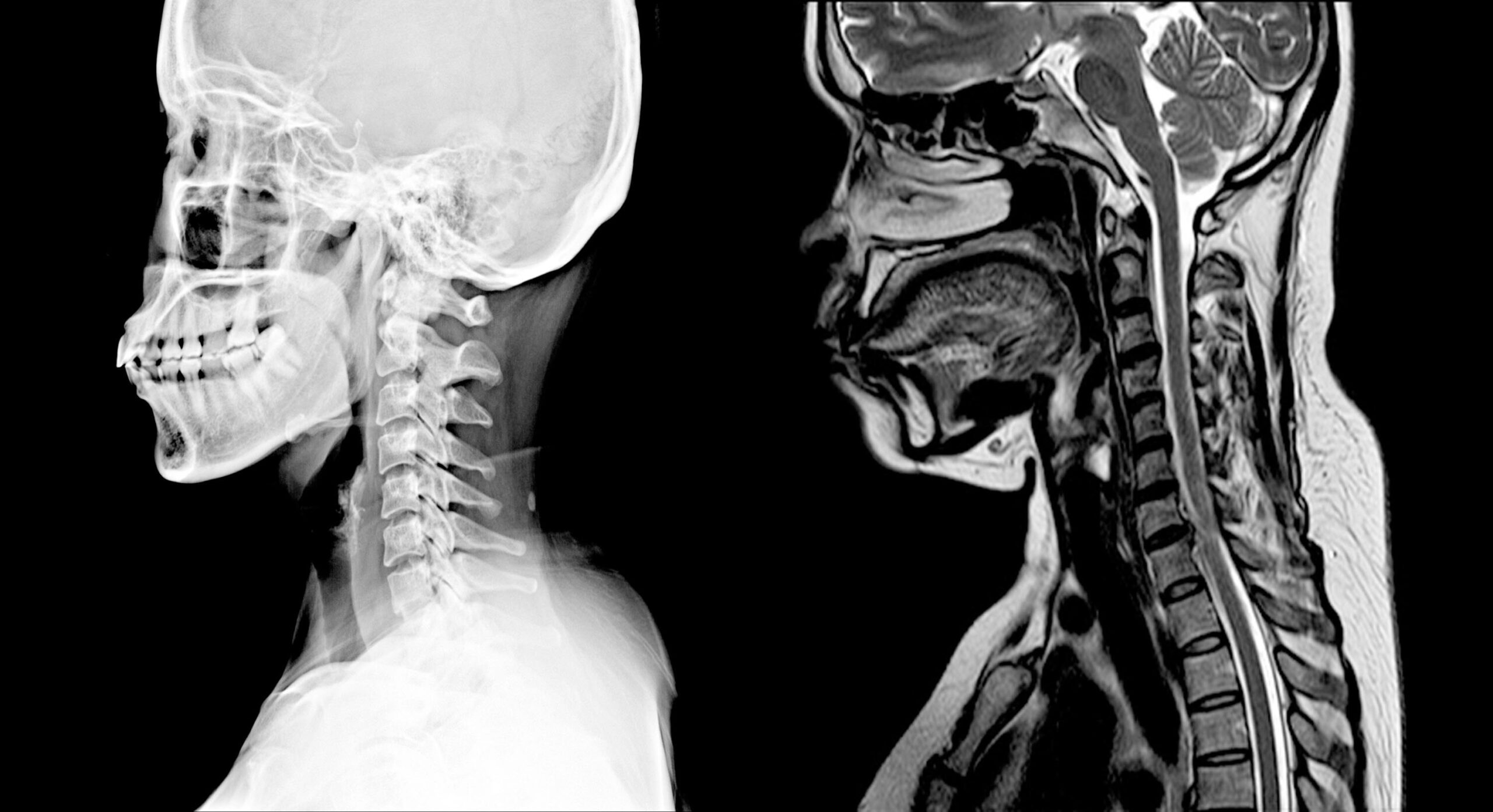 cervical spine mri scan