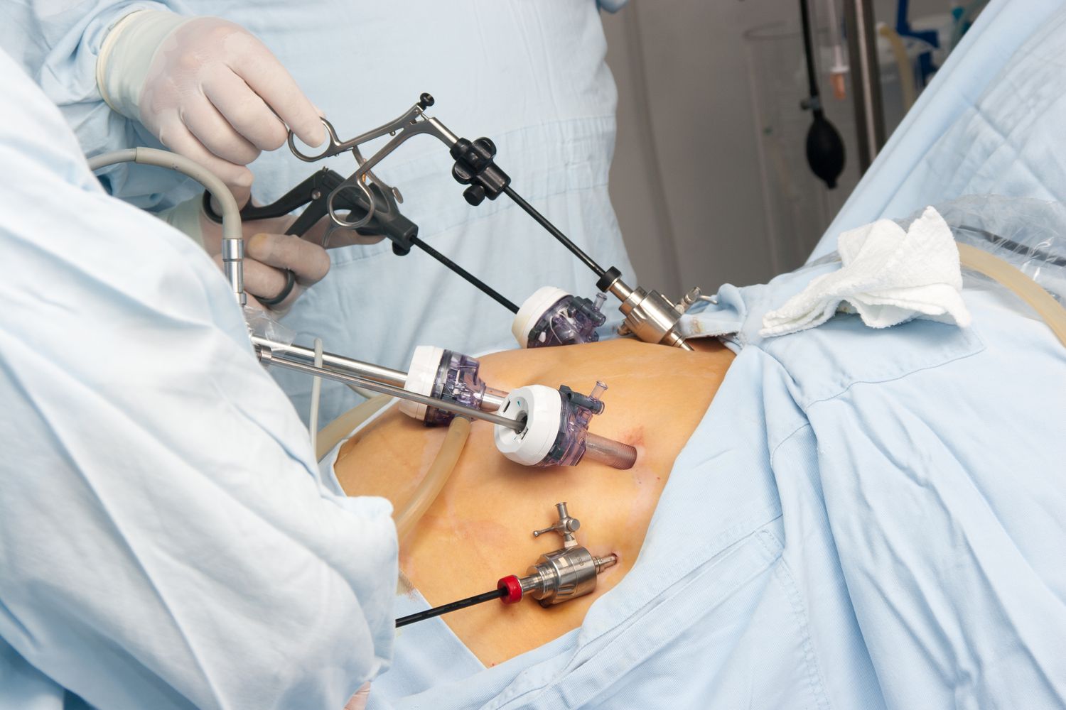 gastric surgery operating room
