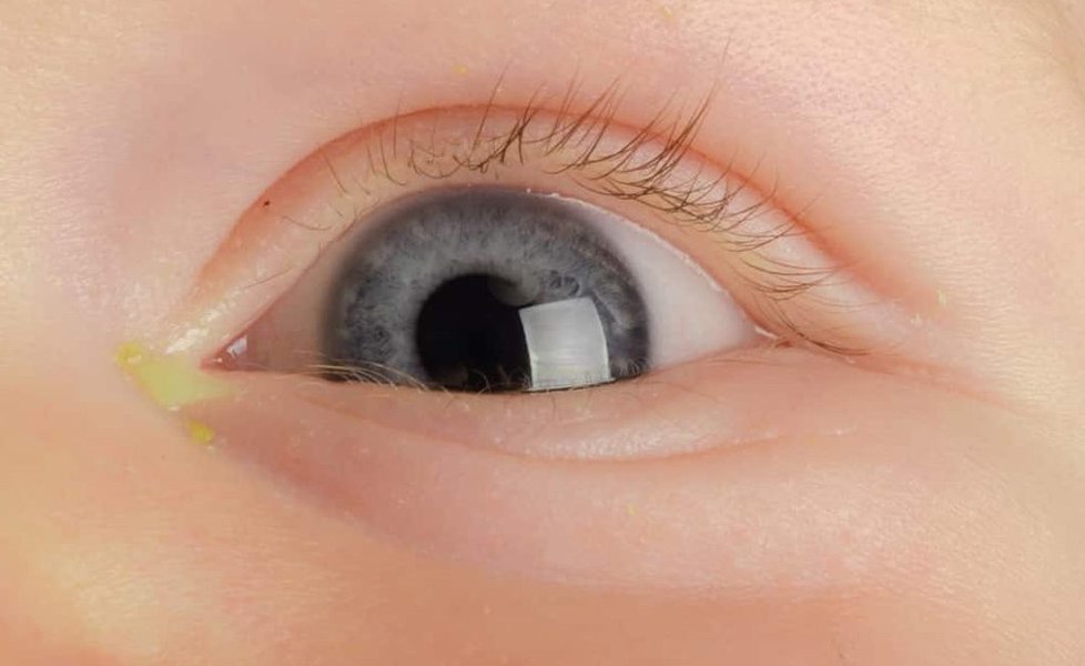 Illustration of eye discharge in a toddler