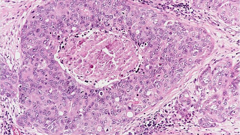 microscope cells breast cancer