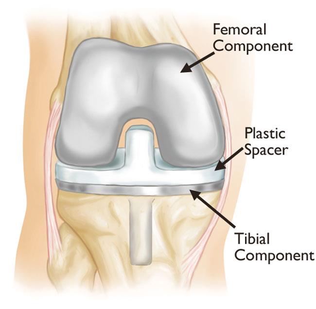revision total knee arthroplasty surgery
