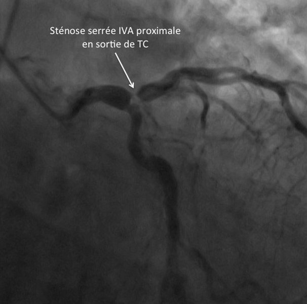 Image d'une sténose serrée de l'IVA vue en coronarographie