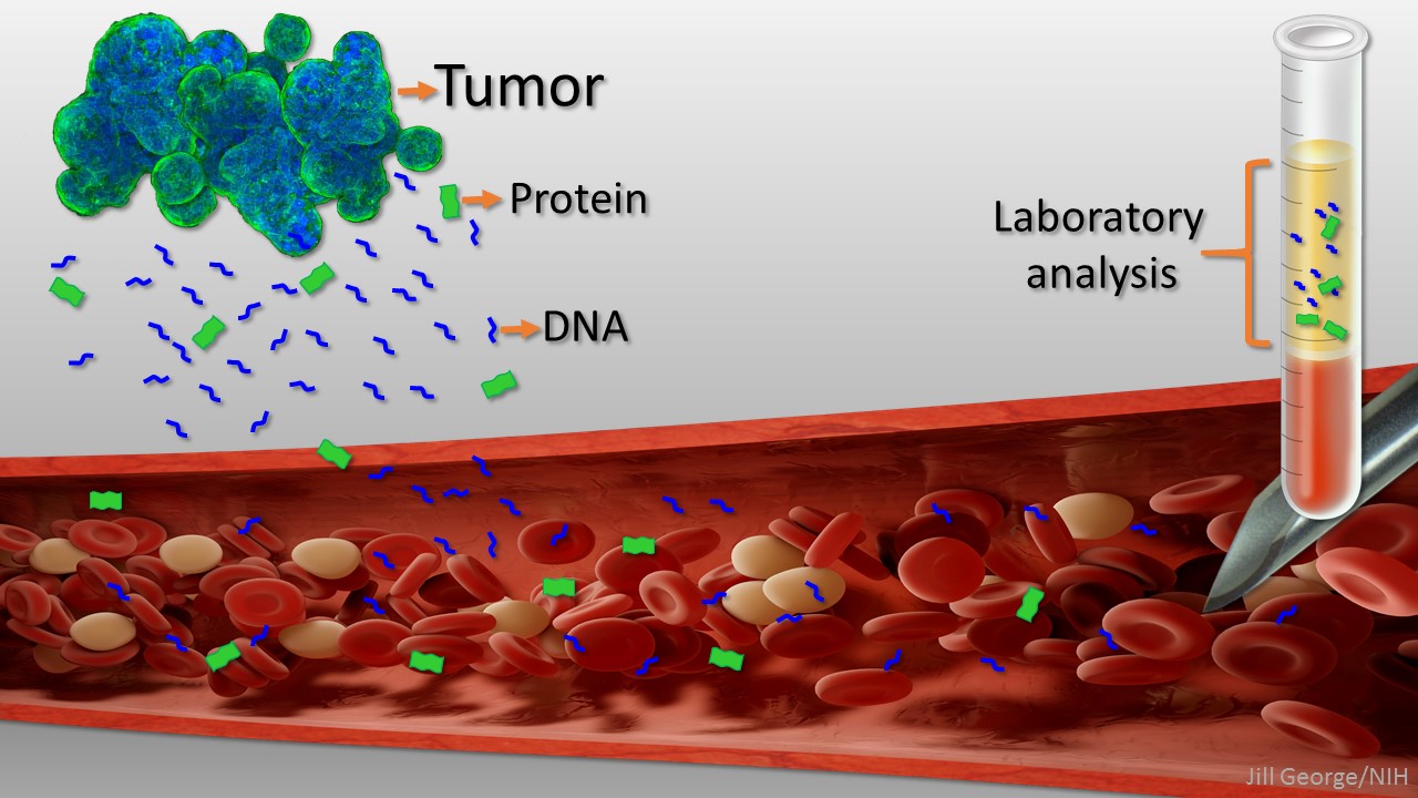 cancer breast biopsy liquid technology