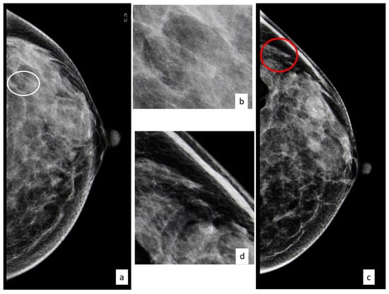 breast lesion diagnostics