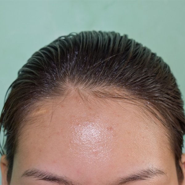 Oily skin on forehead
