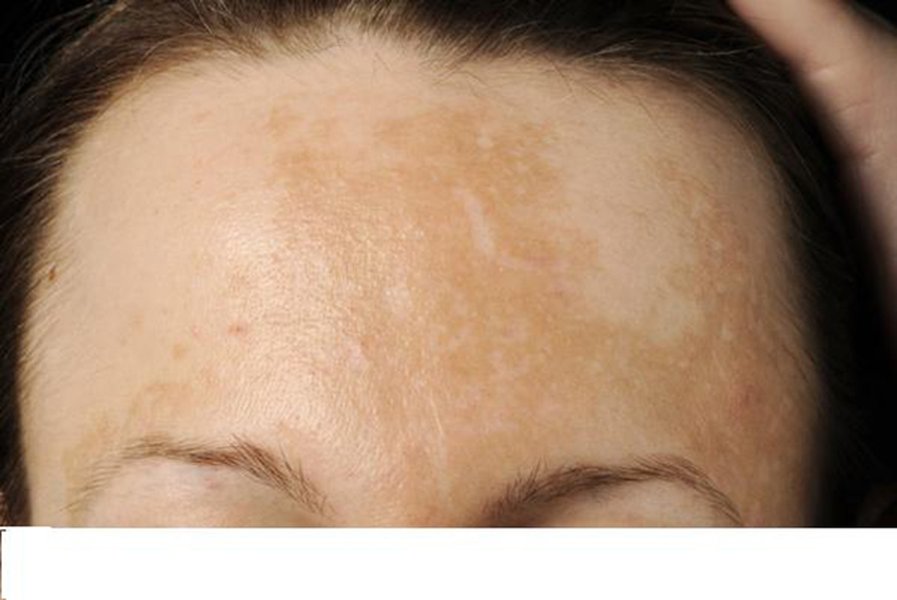 dark-forehead-oily-skin-causes-gm664iku