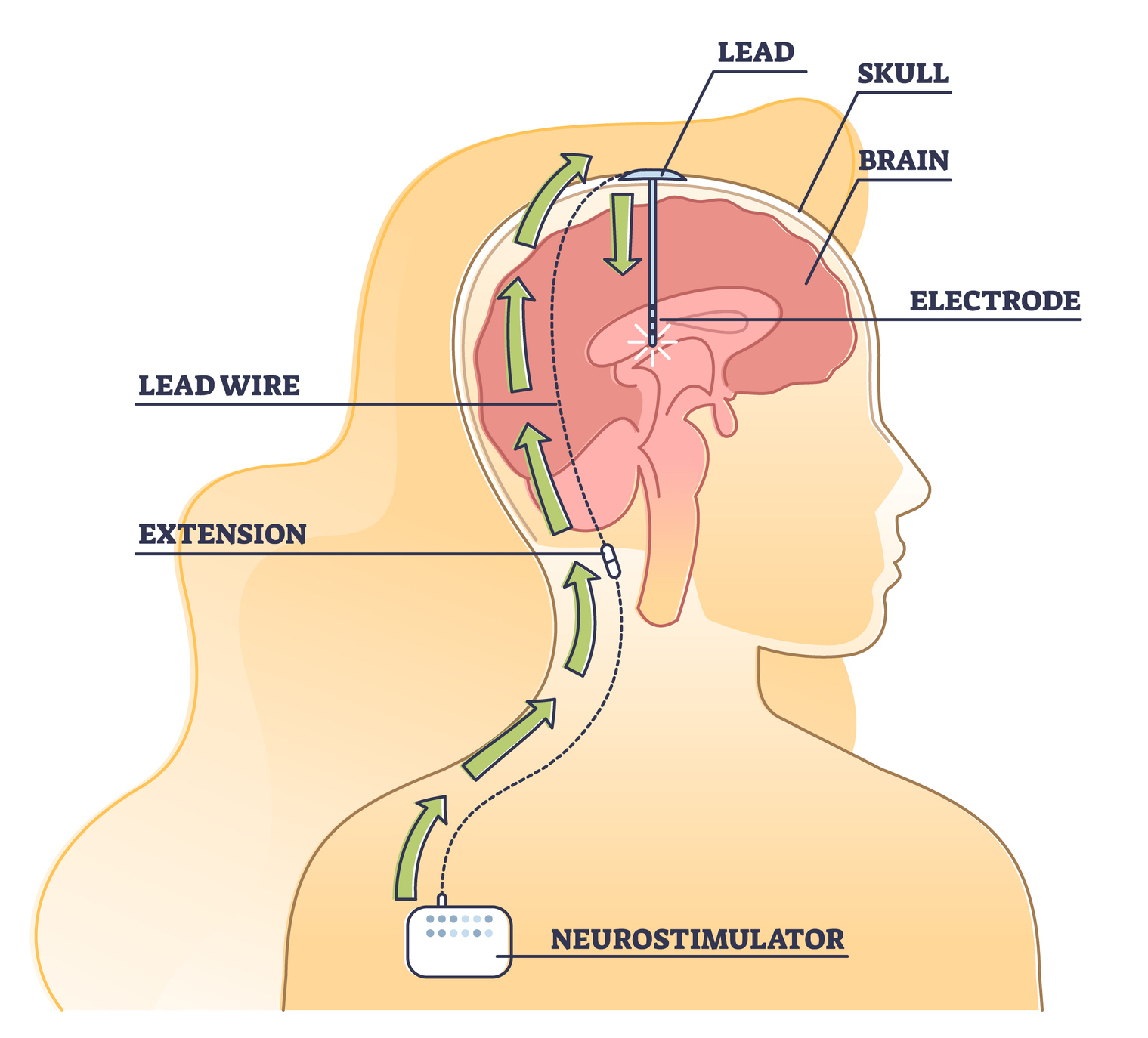 deep brain stimulation surgery