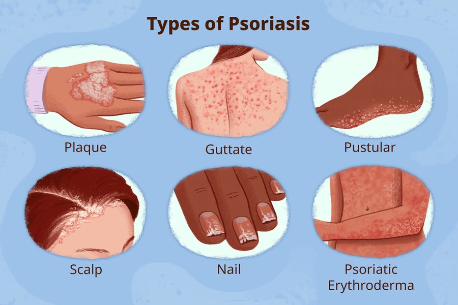 Various types of psoriasis illustrated