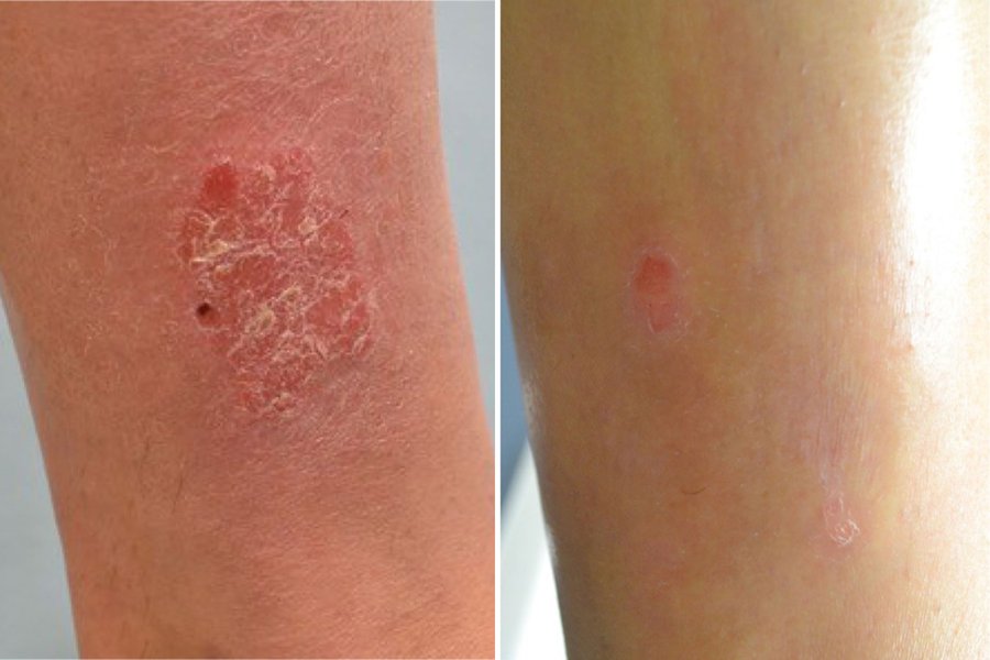 Patient undergoing excimer laser therapy for psoriasis