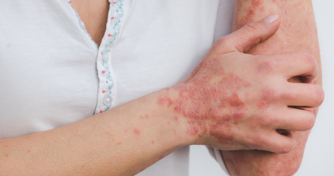 define-psoriasis-and-management-bm7pdlg0