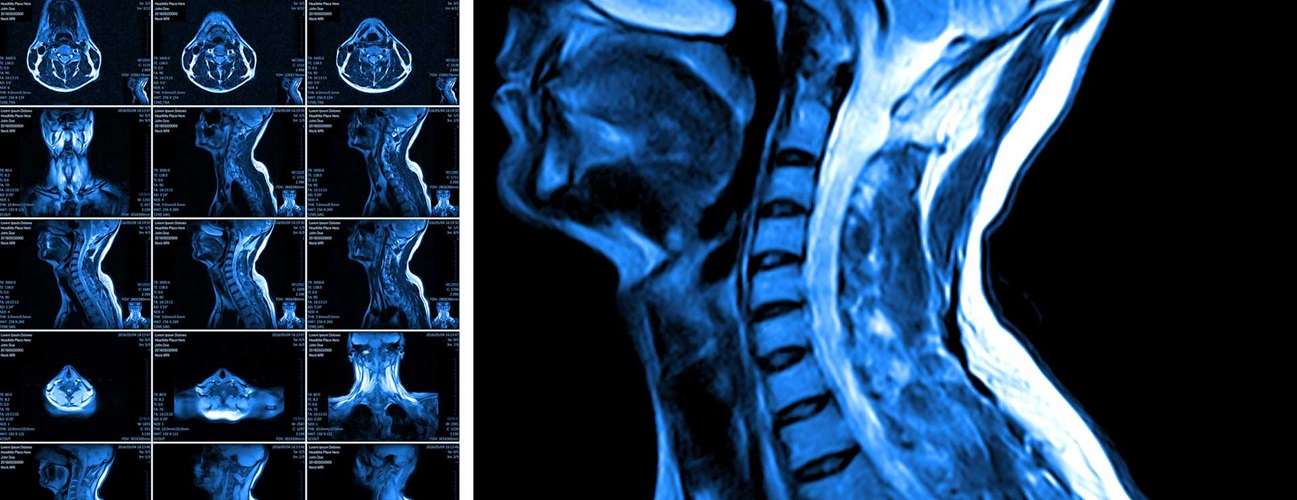 cervical spine medical diagnosis