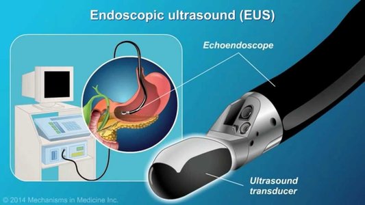 gastric cancer endoscopy equipment