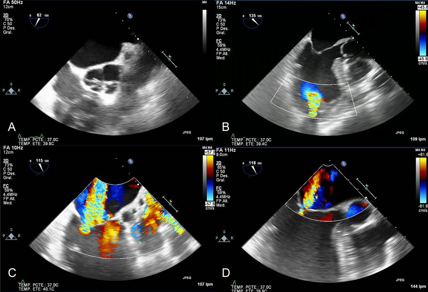 echocardiogram-findings-systolic-dysfunction-ab454m8a