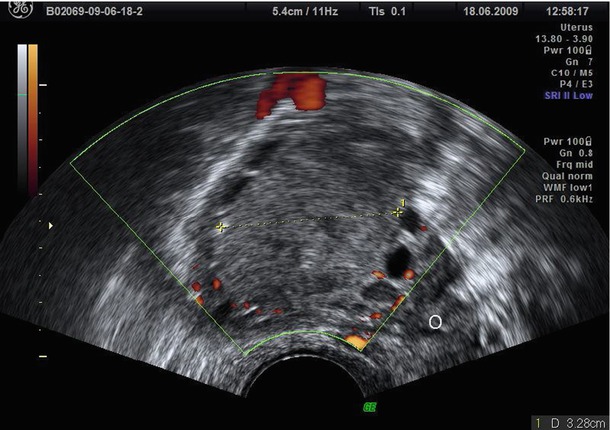 ovary ultrasound scan endometrioma