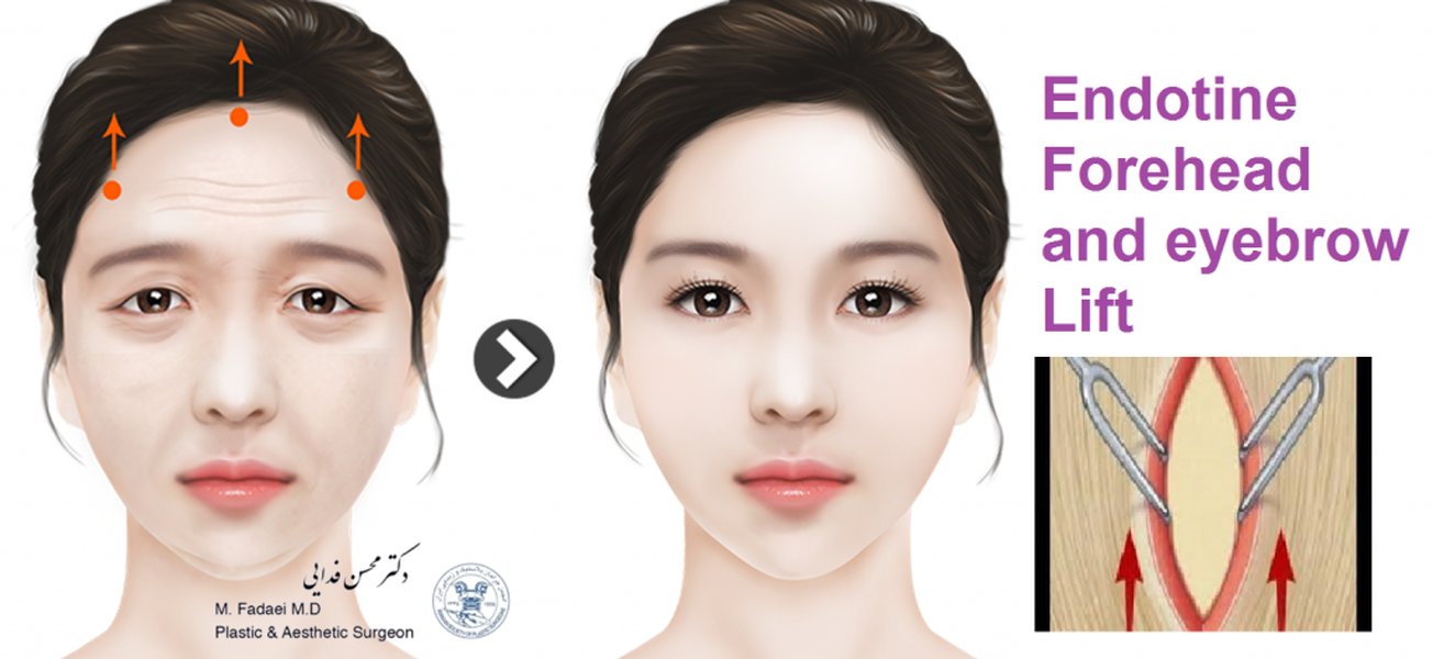 ภาพแสดงตำแหน่งการเปิดแผลบริเวณขมับและแนวทางการยกกระชับใบหน้า