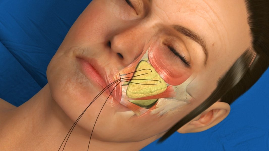 endoscopic-endotine-midface-lift-guide-26eap7md