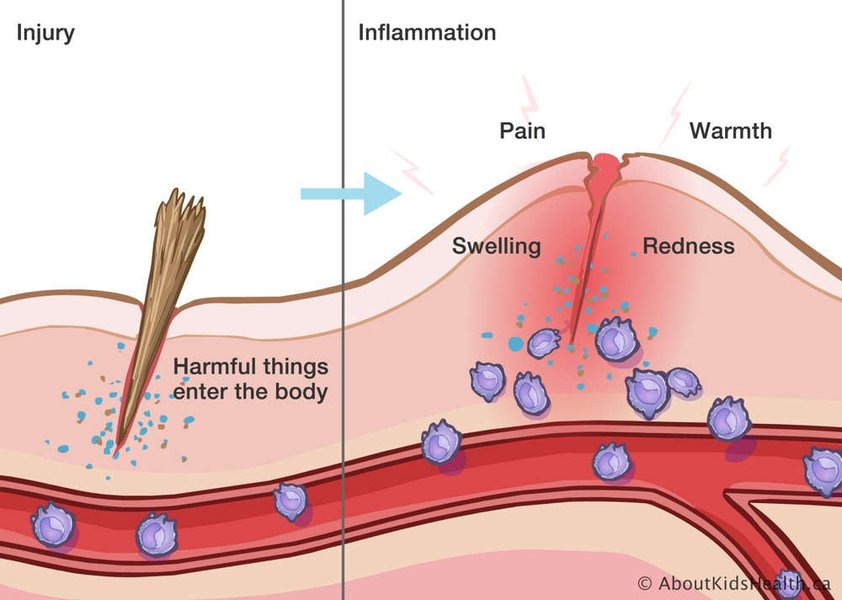 Illustration médicale de l'inflammation