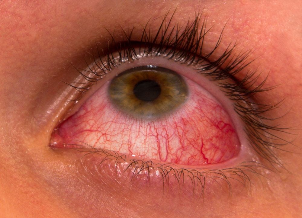 close up of eye infection treatment