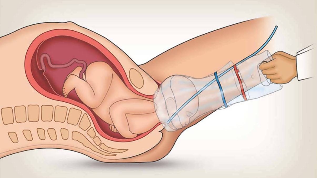 childhood genital anatomy and medical equipment