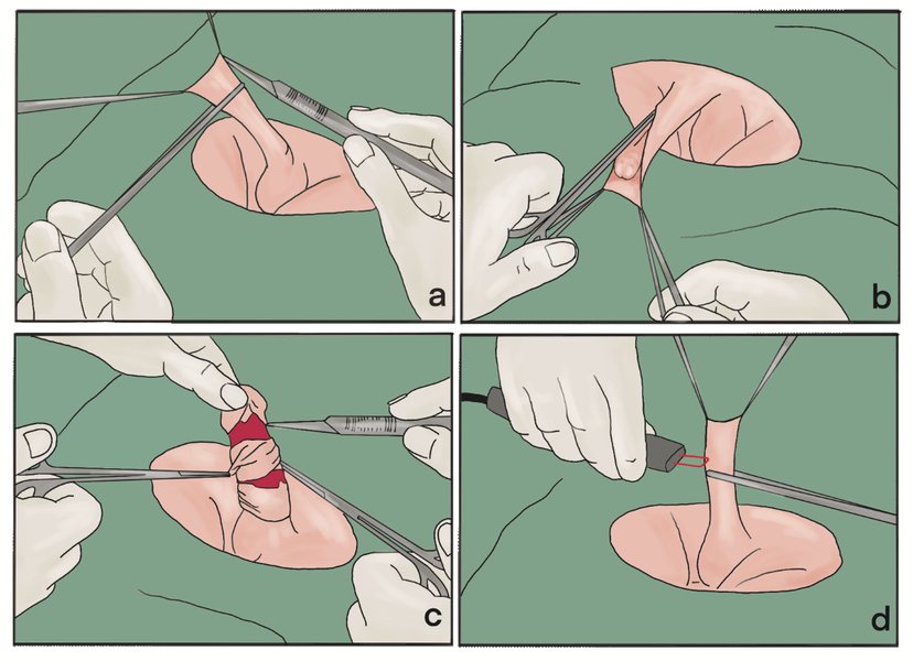Diagram illustrating aspects of circumcision