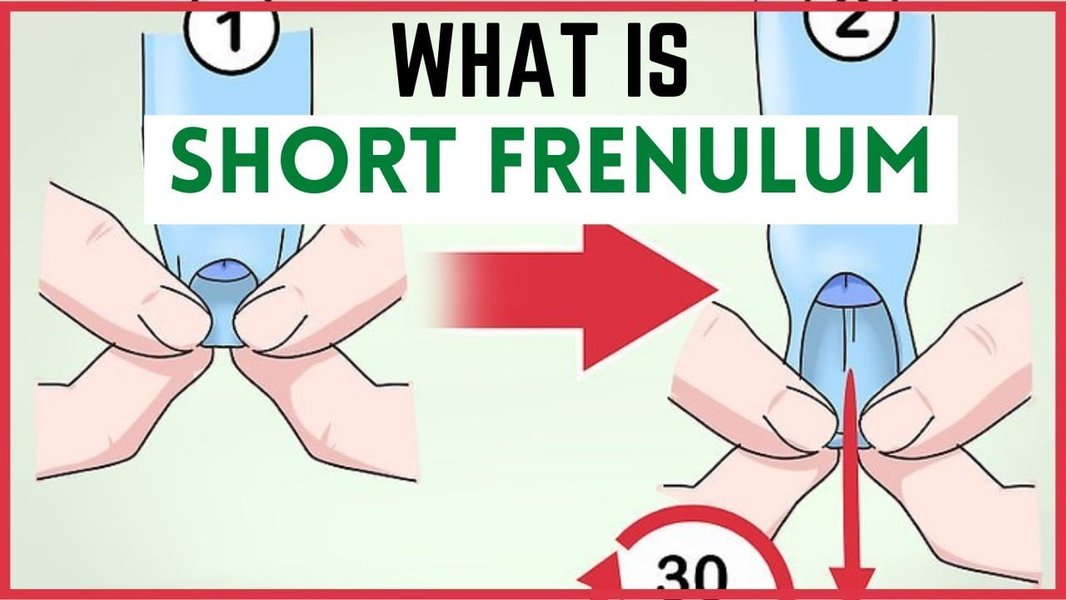 frenulum-skin-transparency-removal-po7l16g3