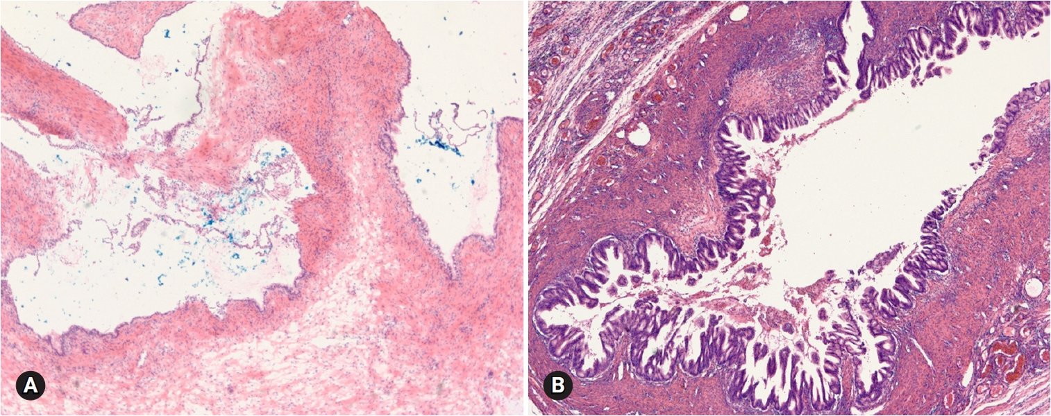 frozen-section-ovarian-masses-7j0koskh
