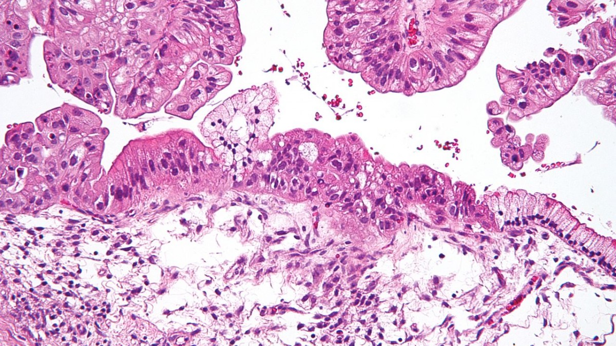 ovarian tumor frozen section microscope surgery