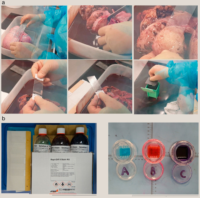ovarian tumor frozen section analysis