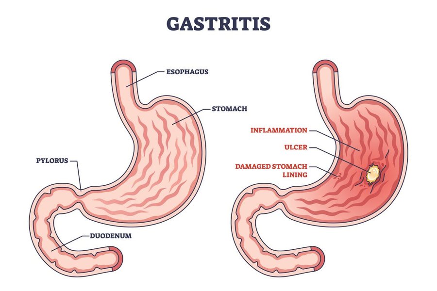 gastritis-relief-healing-guide-t65m4d32