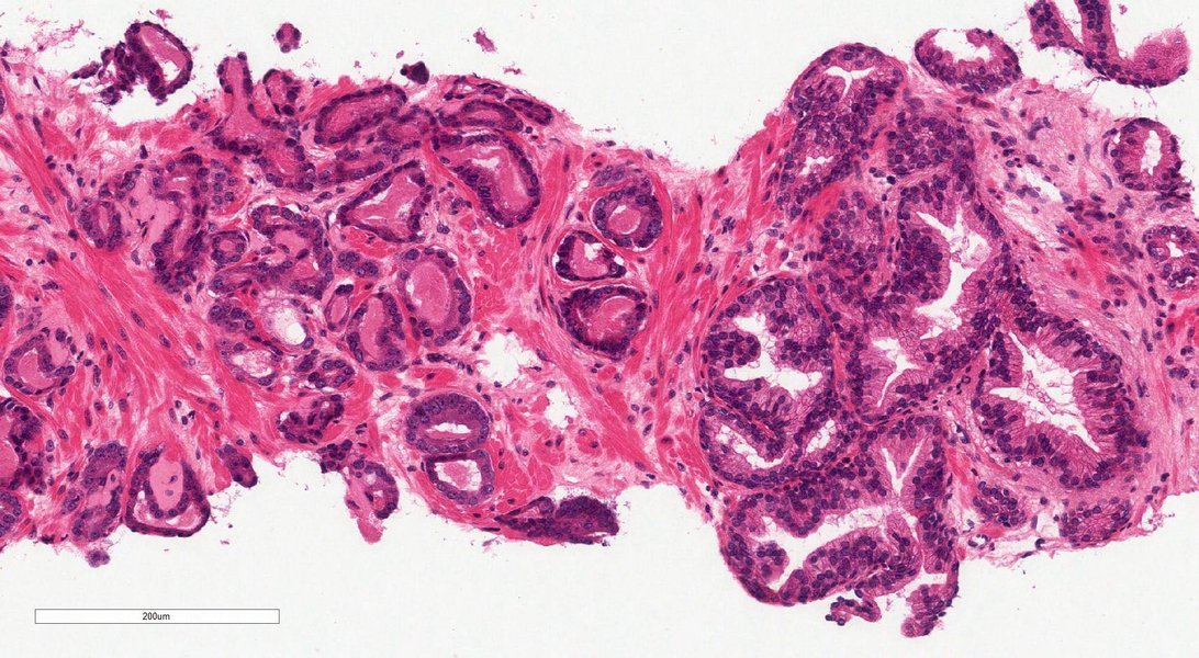 gleason-9-prostate-cancer-bladder-expectancy-jt2brluz