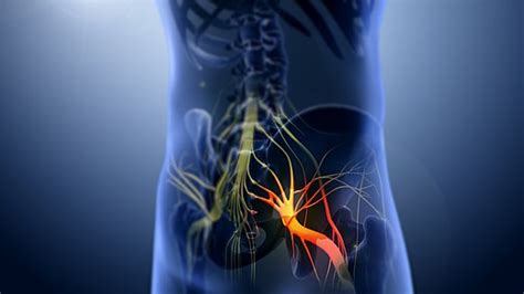 sciatica relief therapy