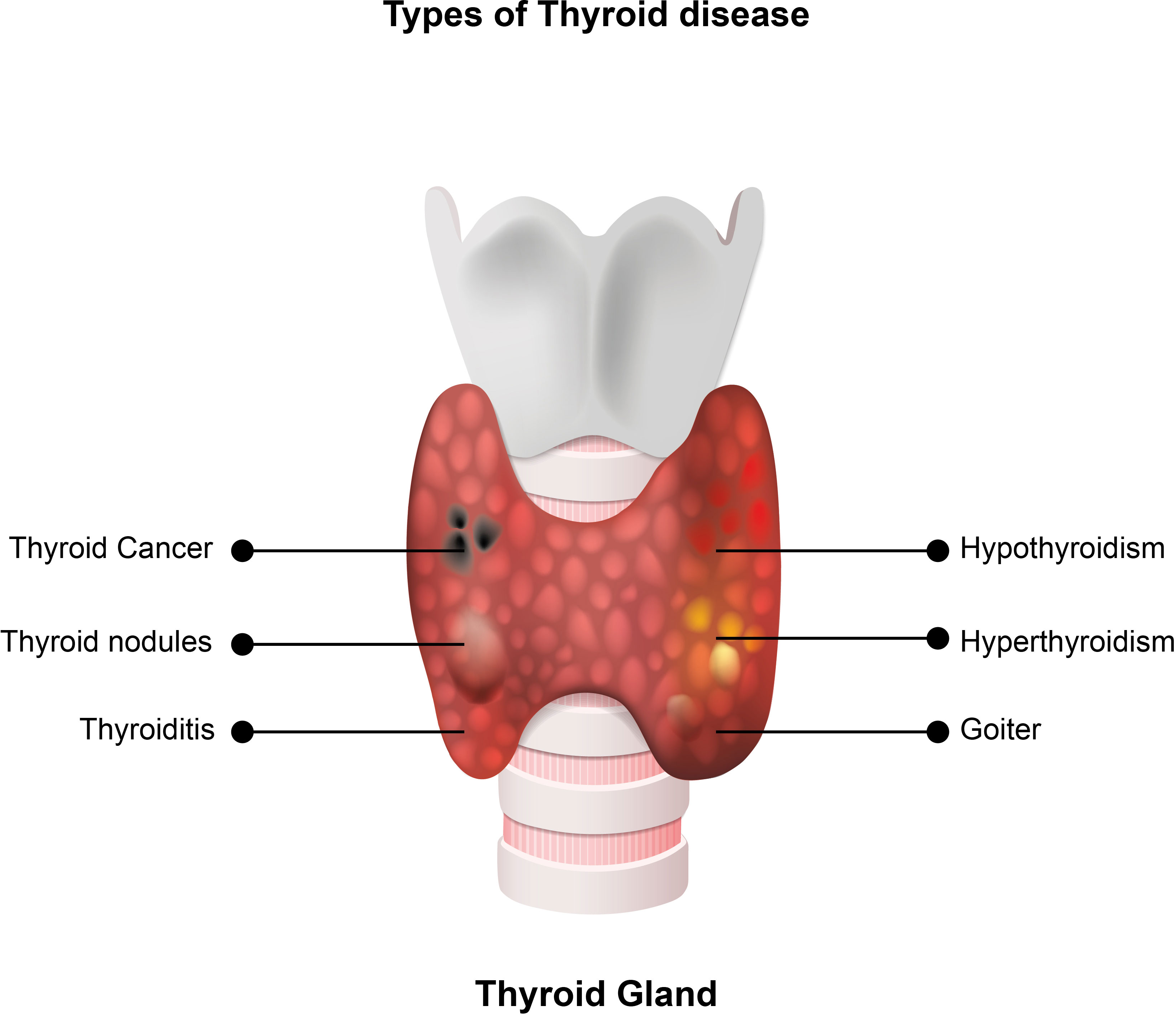 thyroid gland, autoimmune process, medical monitoring