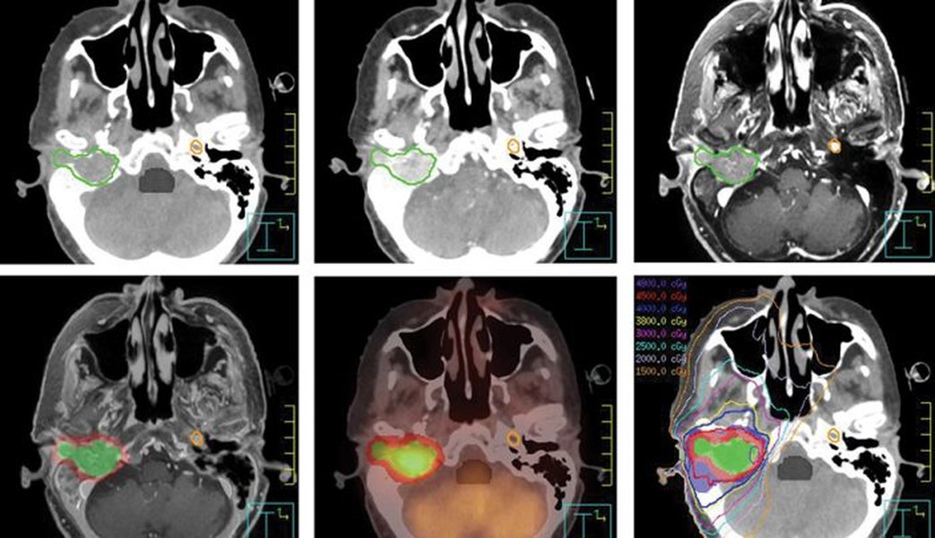 Imagen relacionada con el tratamiento del cáncer de cabeza y cuello