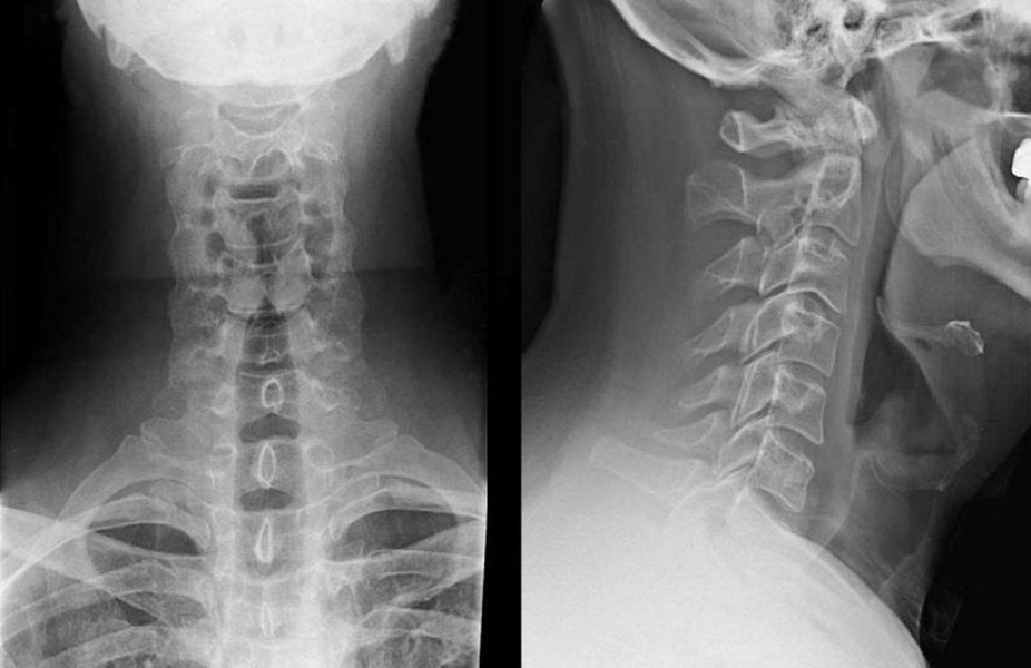 Radiografía de columna cervical
