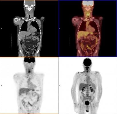 head and neck cancer molecular imaging technology