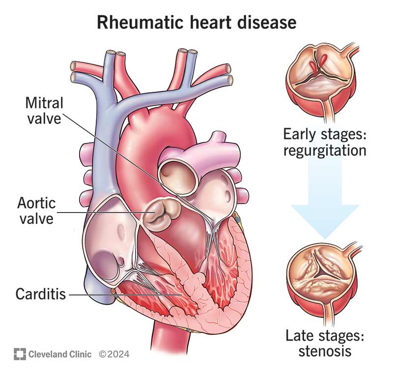 heart failure and rheumatic joint care